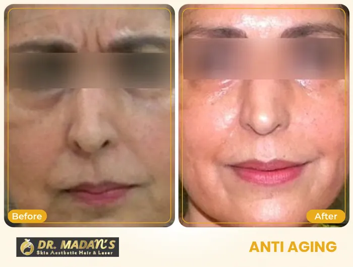 Anti aging before and after result 1 at Dr Madan Aesthetics
